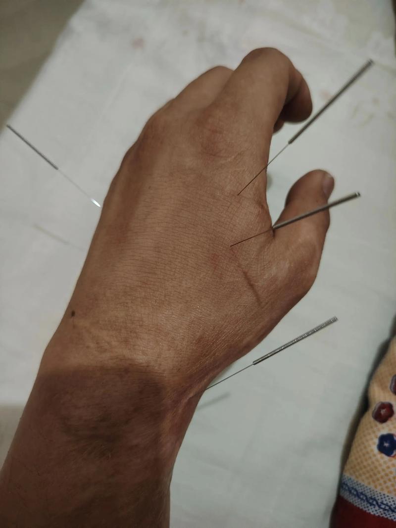 针灸能不能治寻麻疹