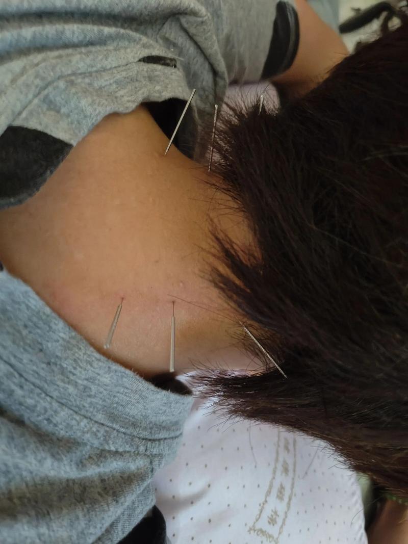 后脑勺疼可以针灸吗