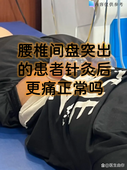 腰间盘膨出针灸治疗