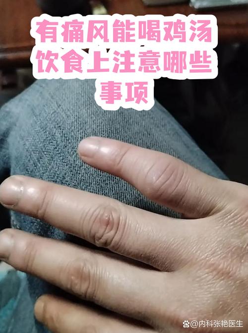 痛风能吃老母鸡汤吗