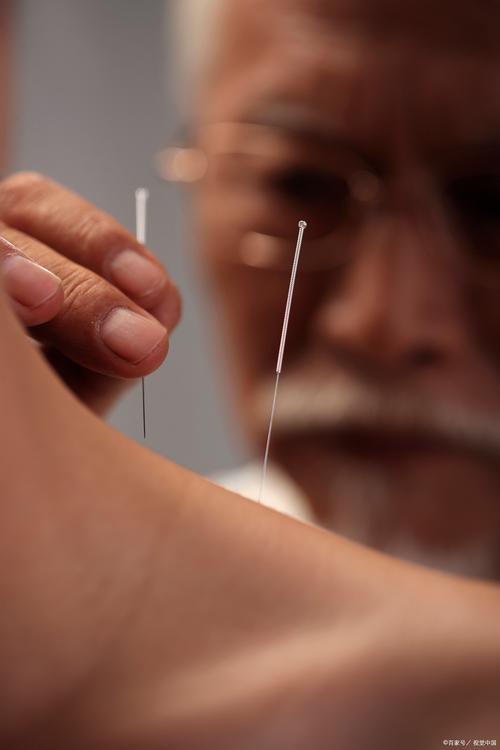 针灸治疗颈椎病图片