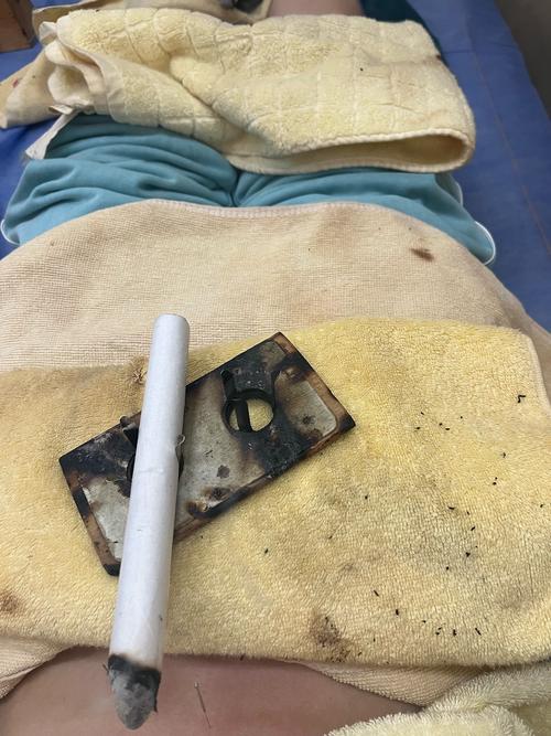 铜陵中医院针灸减肥