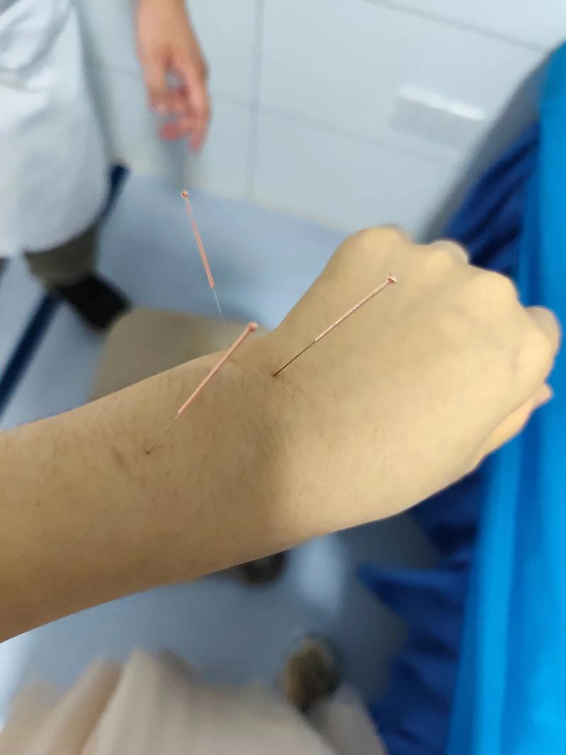 董氏针灸治疗手腕痛