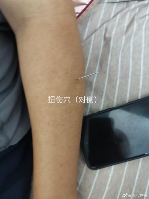 董氏针灸治疗手腕痛