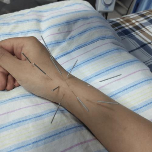 董氏针灸治疗手腕痛