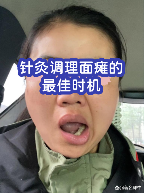 面瘫不针灸能治好吗