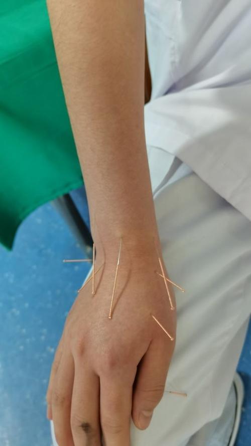 荨麻疹针灸那个部位