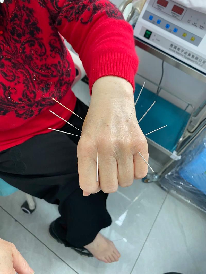 脊髓损伤针灸有用吗