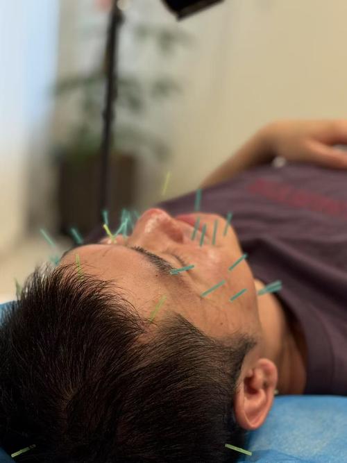 面肌痉挛的针灸穴位