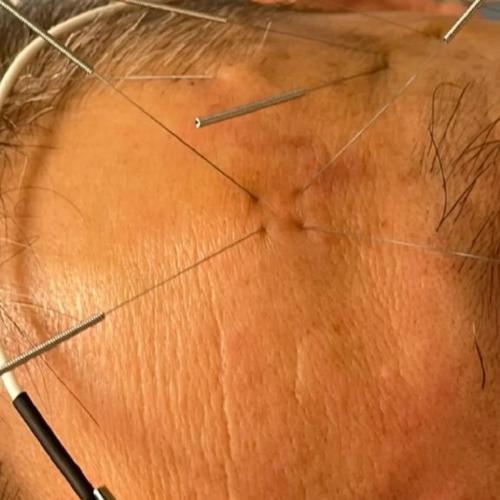 面肌痉挛的针灸穴位