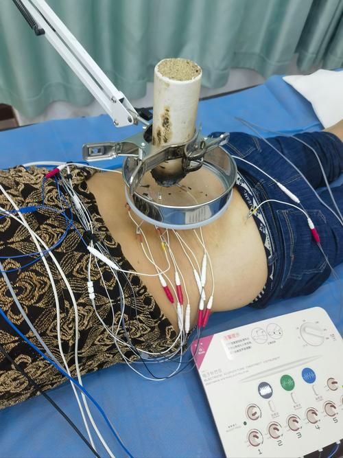 针灸治疗腰间盘视频