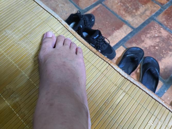 痛风没犯脚也不舒服