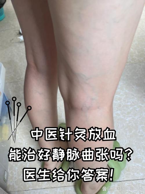 静脉曲张针灸管用吗