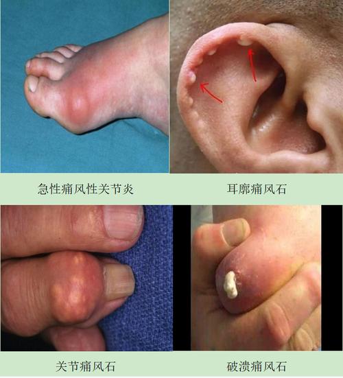 痛风石病的临床表现