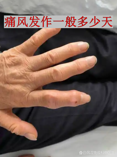 不红不肿会是痛风吗