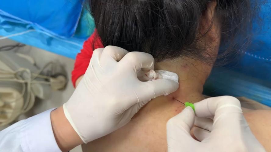 针灸治疗神经性斜颈