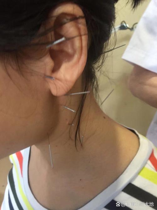 针灸治疗神经性斜颈