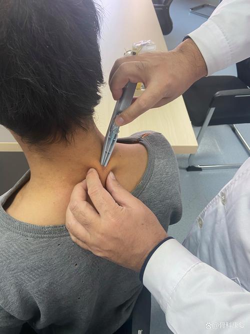 针灸治疗神经性斜颈