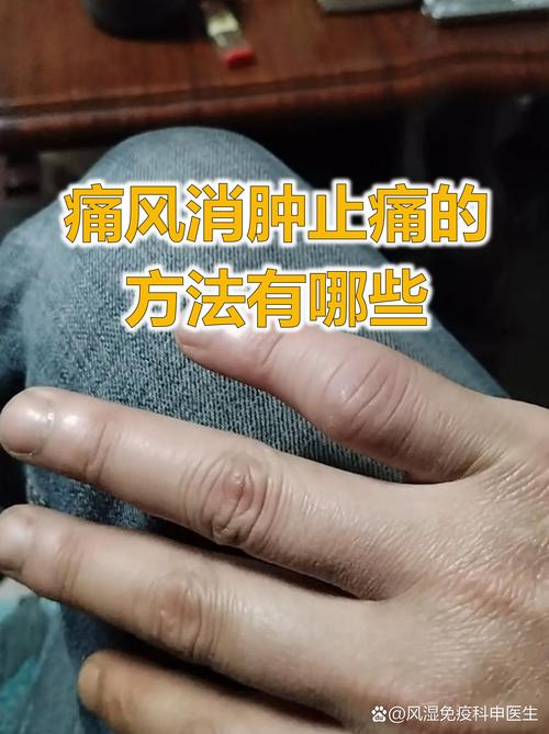 风痹膏是真治痛风吗