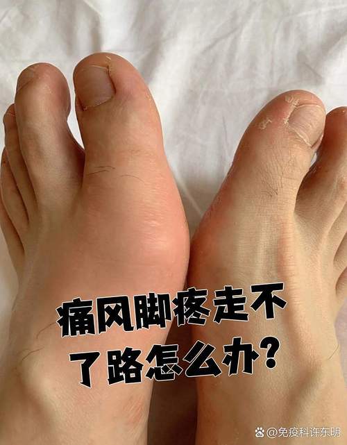 痛风的脚能多走路吗