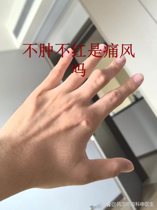 瘦的人会不会得痛风