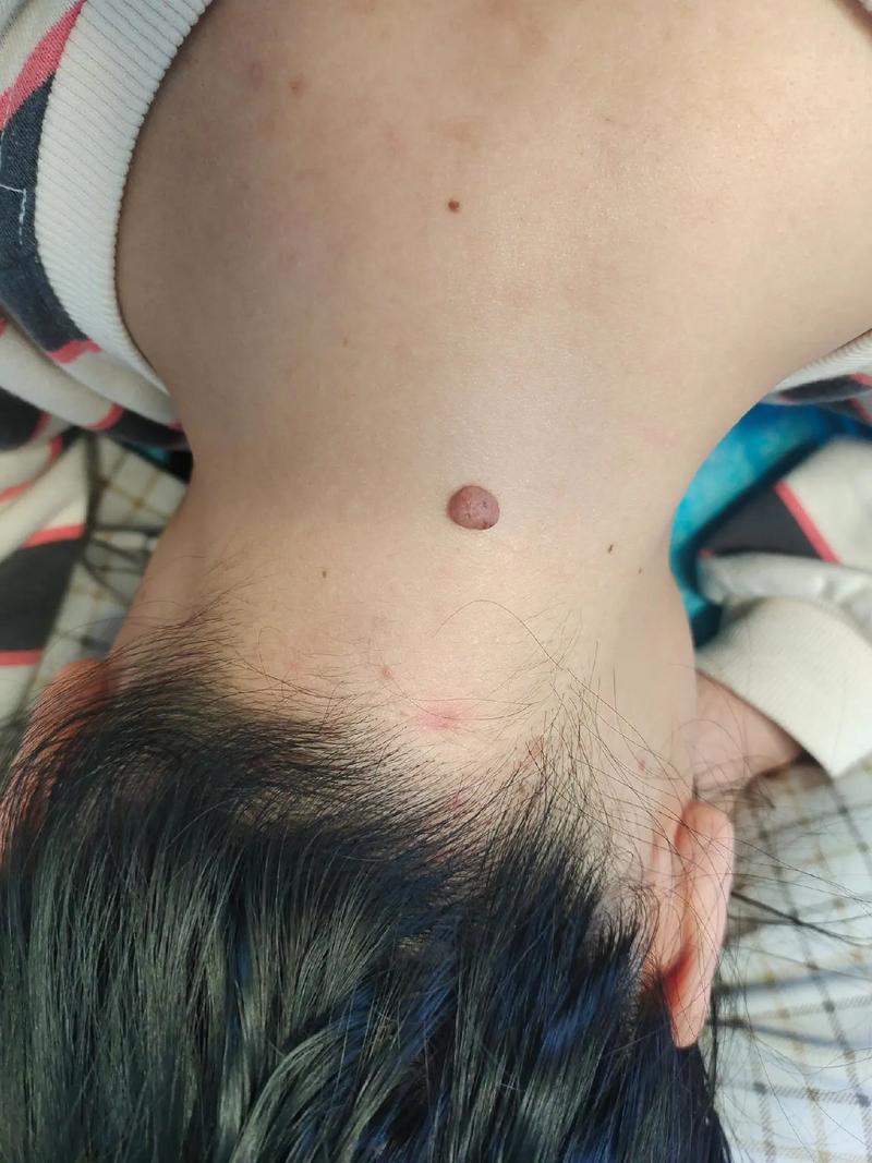 脖子上的痣点掉安全吗