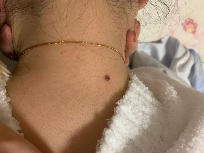 脖子上的痣点掉安全吗