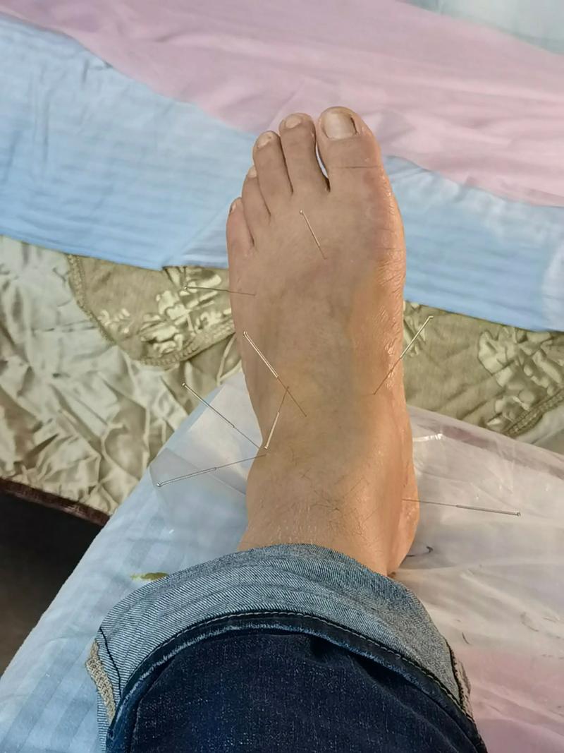 脚后跟疼可以针灸吗