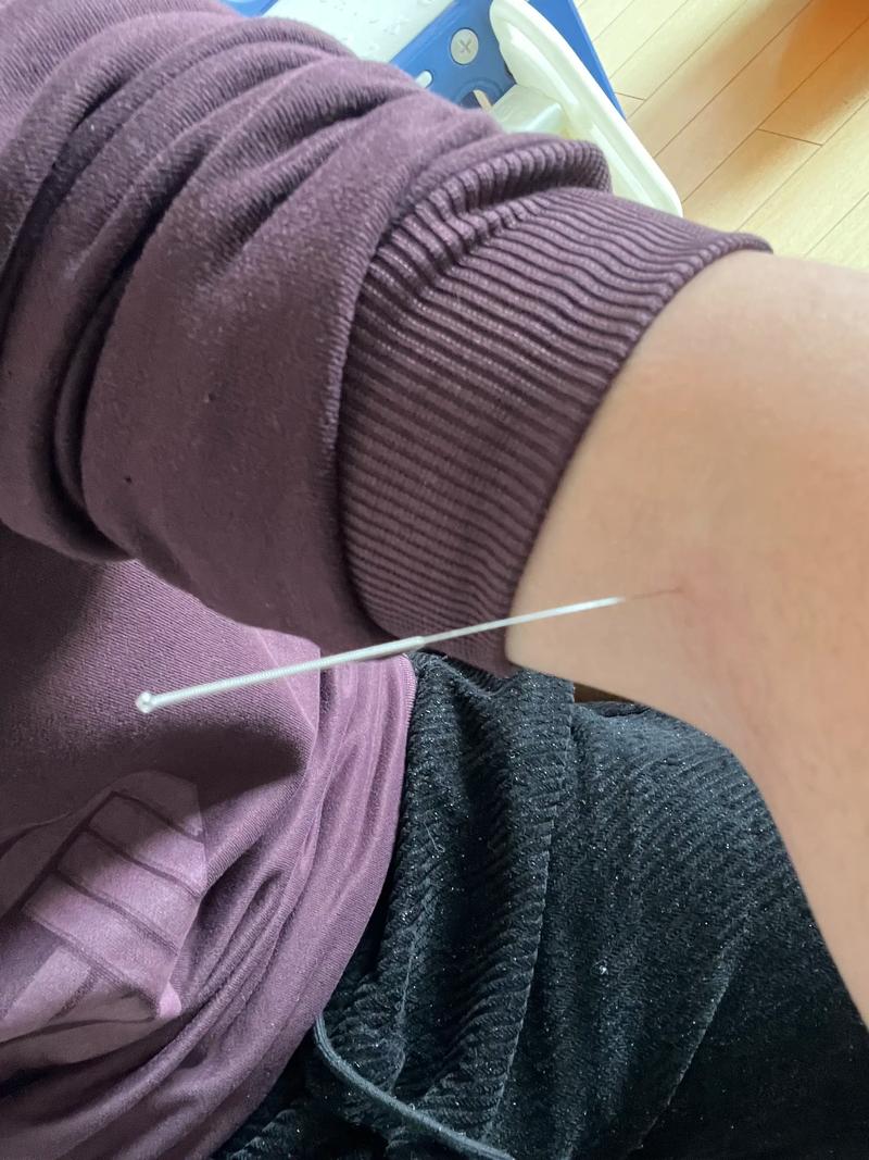 针灸能治好尿潴留吗