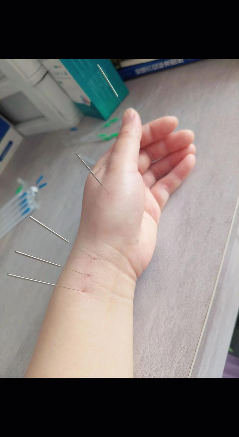 针灸能治好尿潴留吗