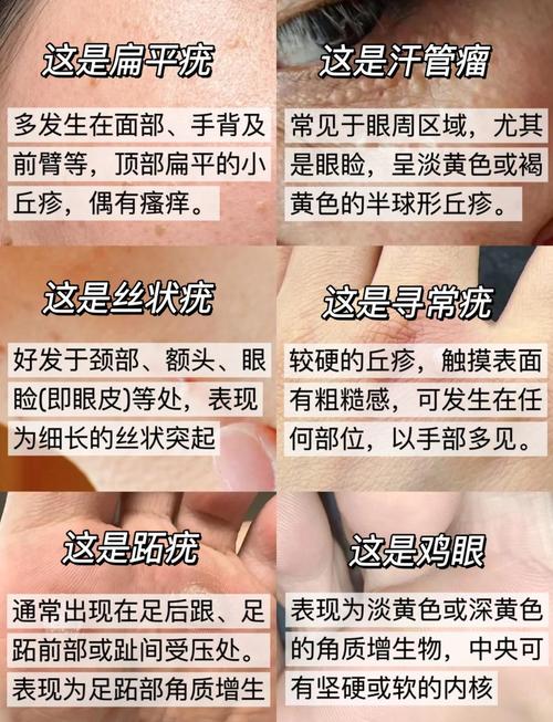 怎样去痦子最安全有效