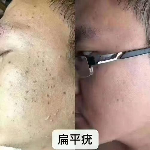 怎样去痦子最安全有效