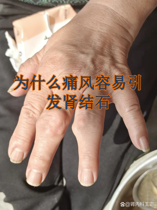 痛风降酸越低越好吗