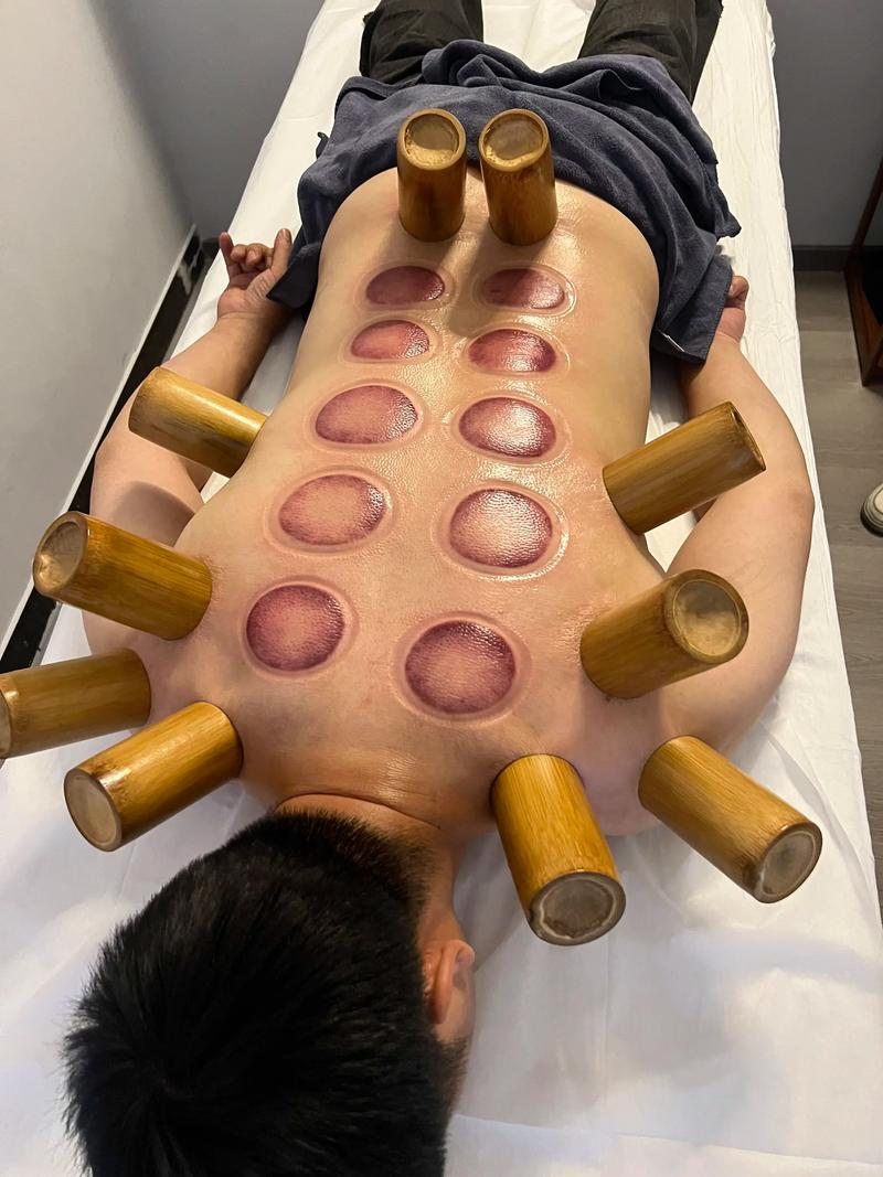 针灸减肥后能洗澡吗