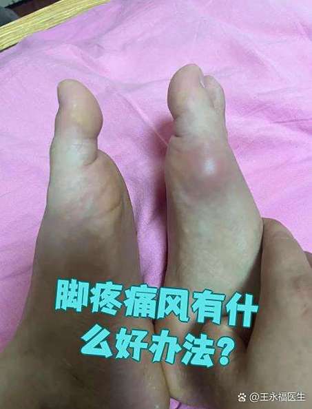 左脚痛风是怎么回事