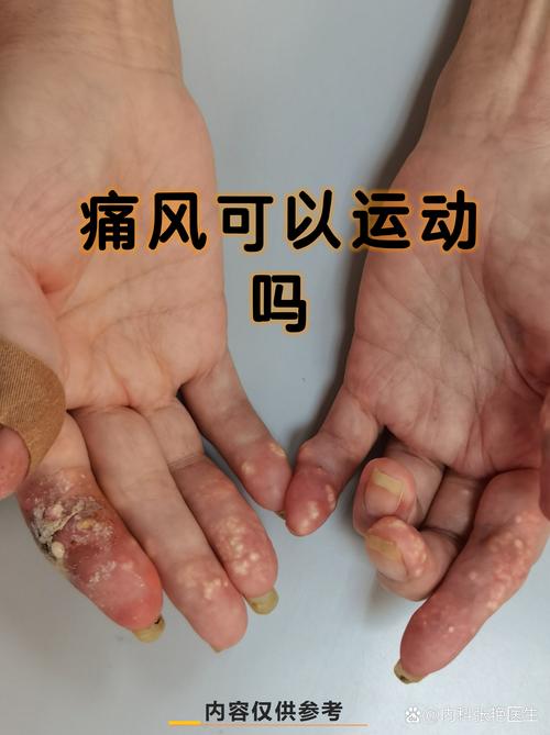 痛风关节炎能跑步吗