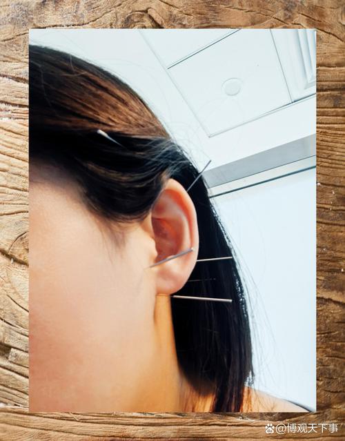 神经性耳鸣针灸穴位