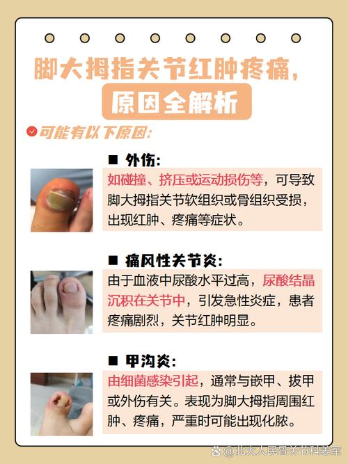 大母脚趾痛风怎么治