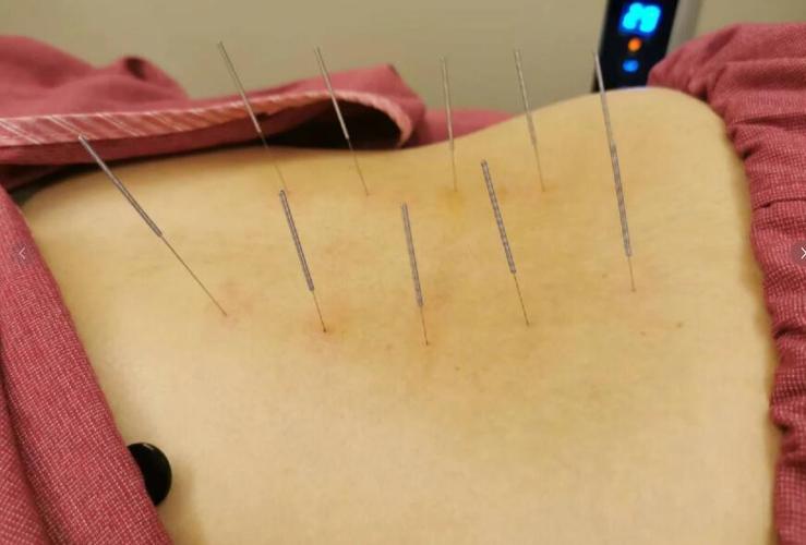 月经结块偏黑做针灸