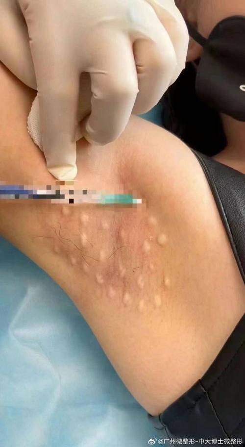 广州治疗腋臭协佳安全