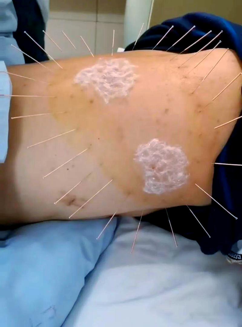 带状疱疹的针灸方法