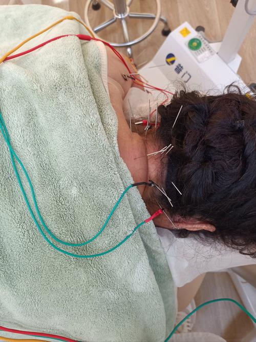 颈椎做针灸副作用吗