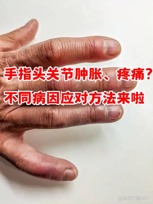 痛风手指关节会痛吗