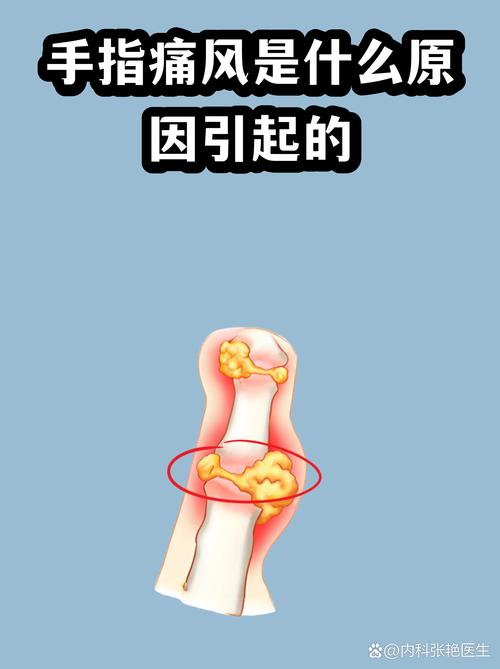痛风手指关节会痛吗