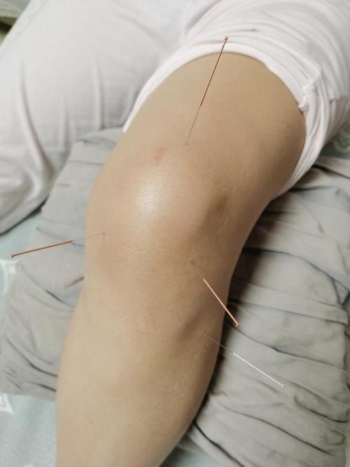 膝盖积水针灸多少钱