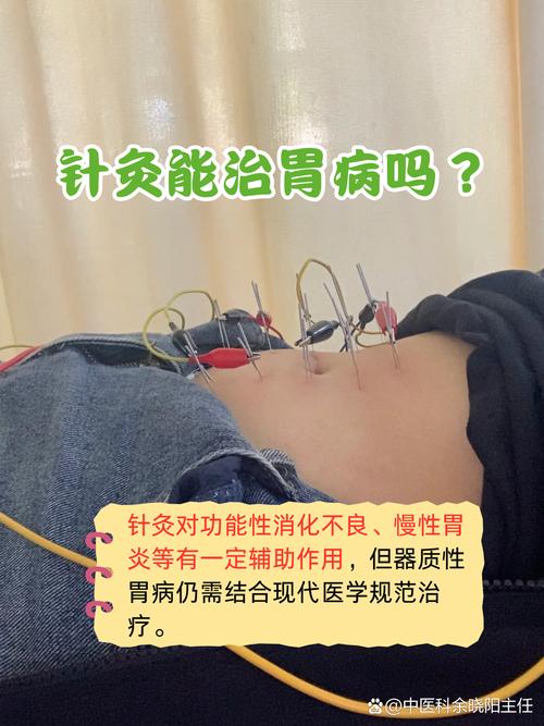 针灸胃下垂多久能好