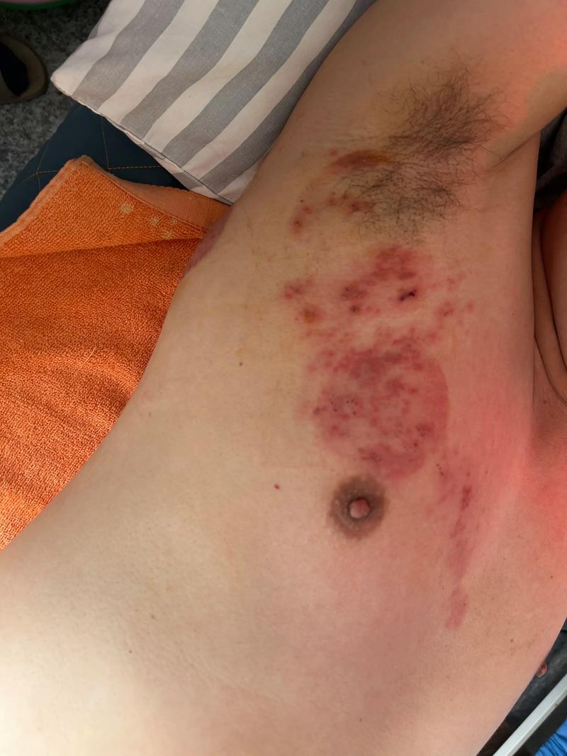 针灸能治疗带状疱疹