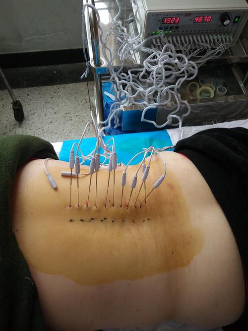 针灸能治疗带状疱疹