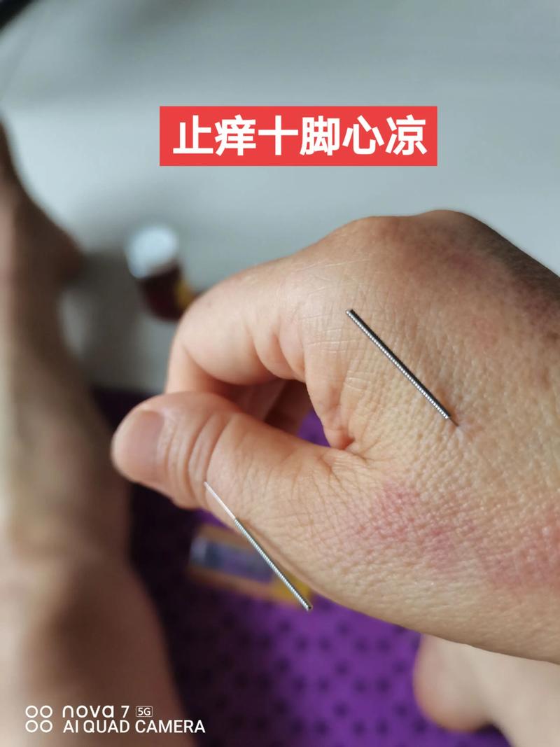 针灸能治皮肤湿疹么