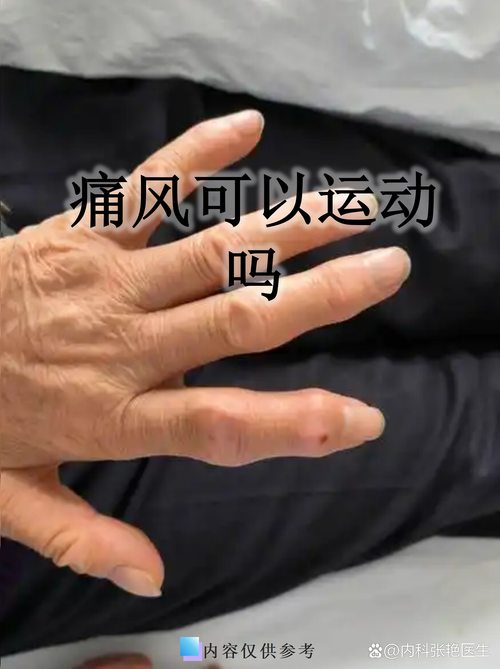 痛风短时间反复发作